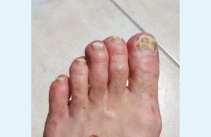 L'eau hydrogénée agirait sur la mycose des pieds, champignon au pied